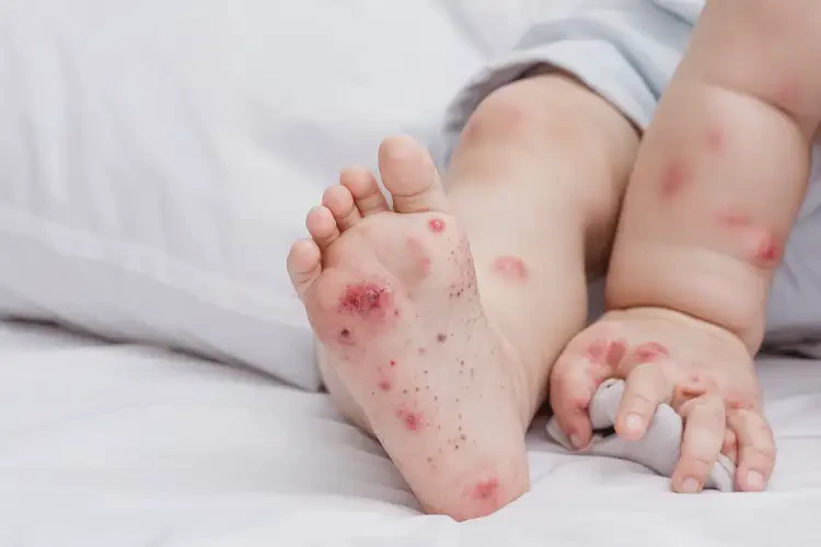 幼兒四肢經(jīng)常起濕疹可以治好嗎(圖4)