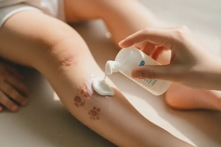 小兒小腿出現(xiàn)濕疹可以治好嗎(圖2)