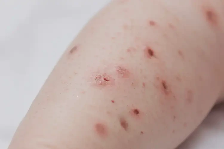 嬰幼兒四肢經(jīng)常起濕疹能夠徹底治愈嗎(圖4)