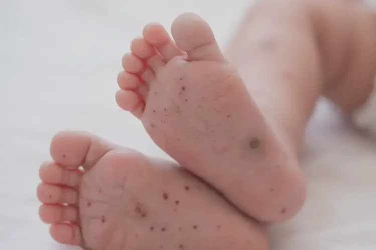 新生兒腳上偶爾起濕疹可不可以根治(圖4)