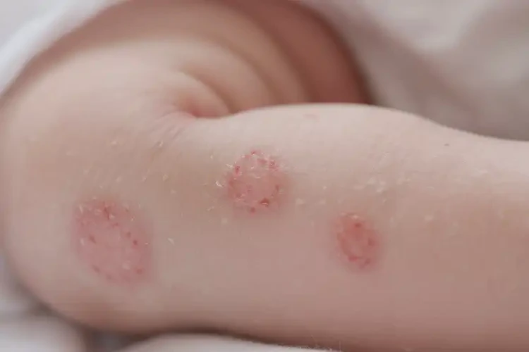 新生兒小腿上起濕疹可以治好嗎(圖4)