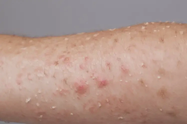 女性四肢容易長(zhǎng)濕疹可以治好嗎(圖4)