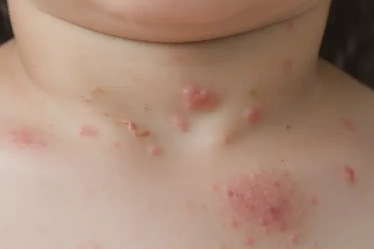 兒童脖子上偶爾起濕疹可以治好嗎(圖4)