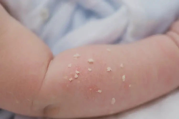 嬰兒手臂容易長濕疹可以治好嗎(圖4)