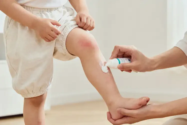 小孩小腿上出現(xiàn)濕疹能夠徹底治愈嗎(圖2)