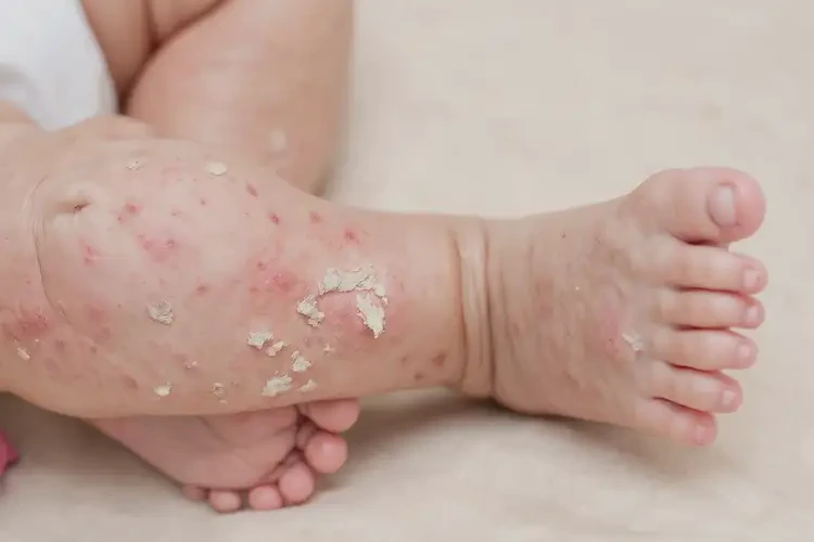 小孩小腿上起濕疹不管它會自己好嗎(圖1)