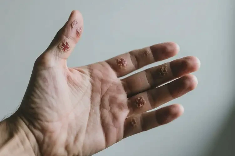 男人手上出現(xiàn)濕疹可不可以根治(圖2)