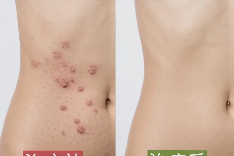 女生肚子上有濕疹可以治好嗎(圖2)