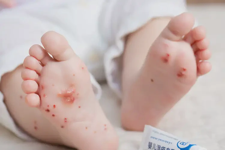 寶寶腳上出濕疹不管它會(huì)自己好嗎(圖4)