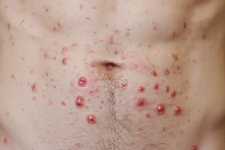 男生肚子上經(jīng)常長濕疹可以治好嗎(圖4)