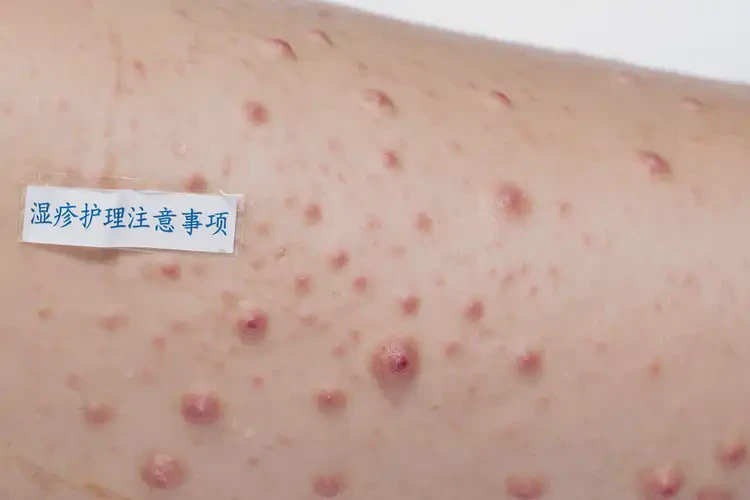 大學(xué)生四肢有濕疹可不可以根治(圖4)