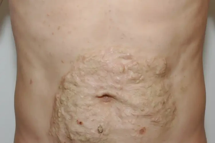 男生肚子上經(jīng)常長濕疹可以治好嗎(圖2)