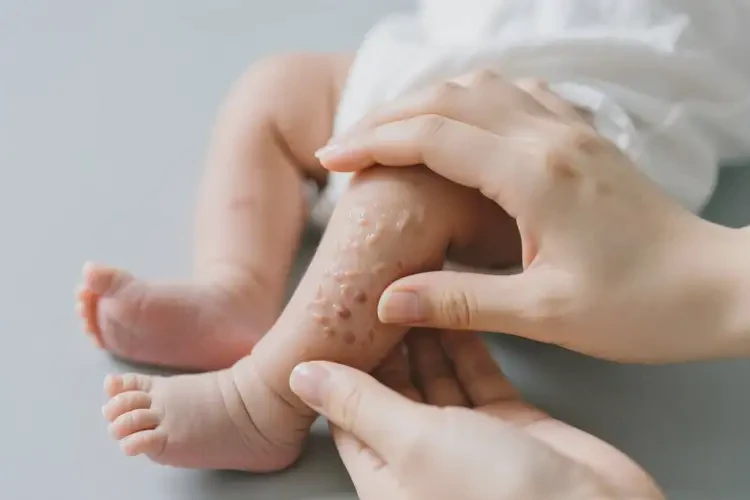 新生兒小腿上出現(xiàn)濕疹可不可以根治(圖2)
