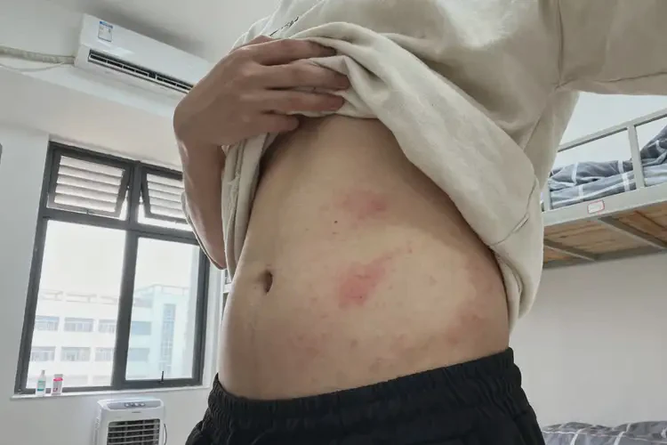 大學(xué)生肚子有濕疹能徹底自愈嗎(圖1)