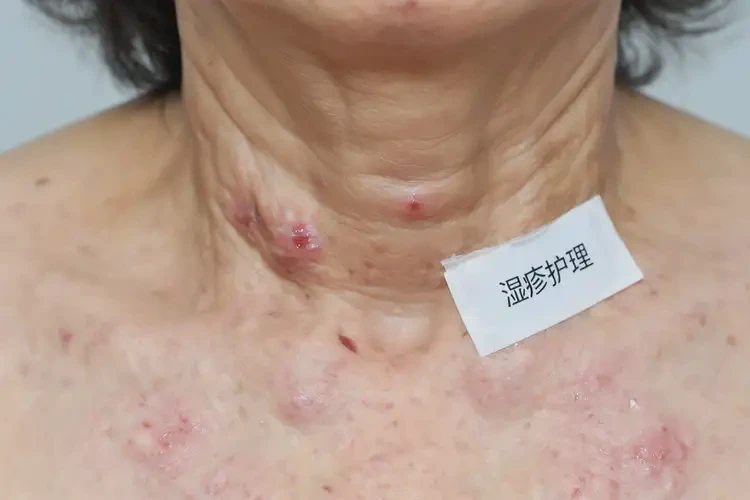 女生脖子上出濕疹可不可以根治(圖4)