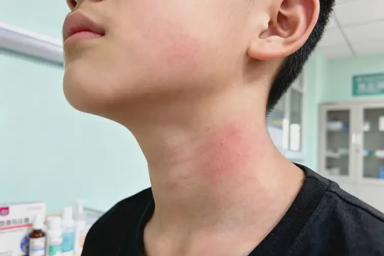 青少年脖子上偶爾長(zhǎng)濕疹可不可以根治(圖2)