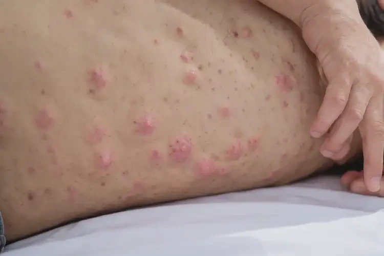 青少年肚子容易起濕疹可以治好嗎(圖4)