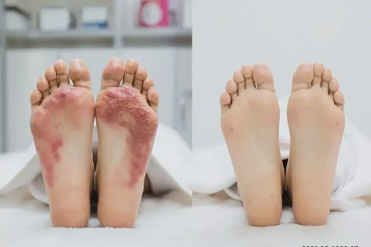 產(chǎn)婦腳上偶爾長濕疹能靠自己自愈嗎(圖4)