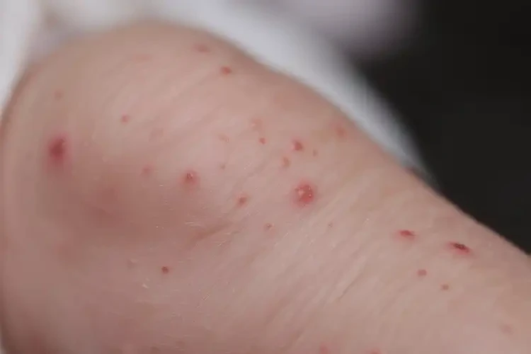 新生兒小腿偶爾起濕疹可以治好嗎(圖4)