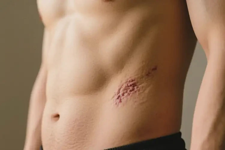 男人肚子長(zhǎng)濕疹可不可以根治(圖3)