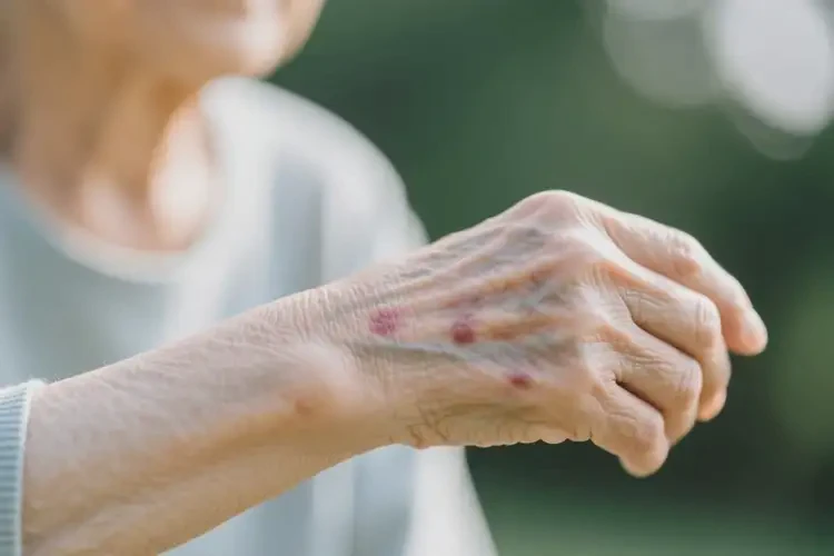 老年人身上经常长湿疹可不可以根治(图2)