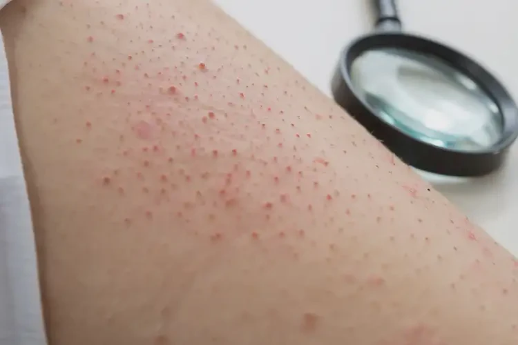 大學(xué)生屁股上起濕疹可不可以根治(圖3)