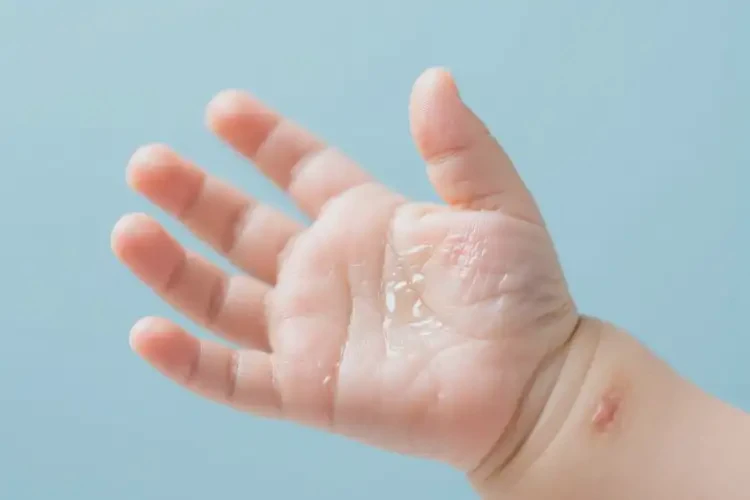 寶寶手上起濕疹可以治好嗎(圖3)