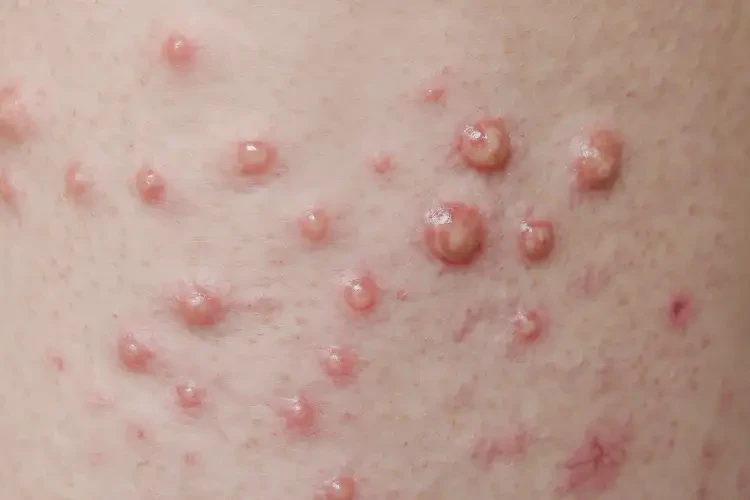 男性肛周經(jīng)常長濕疹可以治好嗎(圖4)