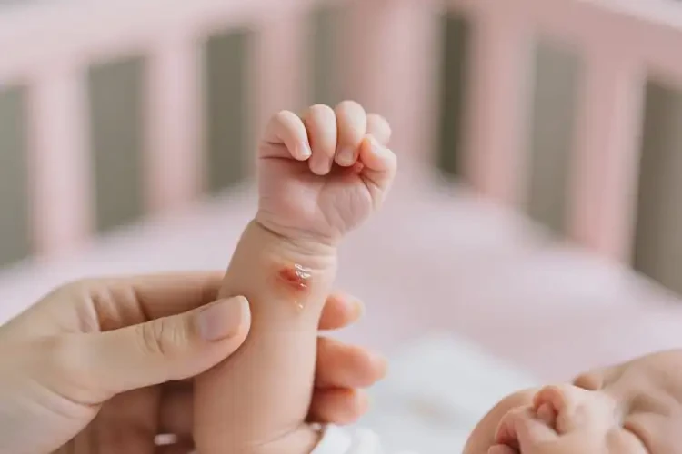 新生兒手臂上出濕疹可不可以根治(圖3)