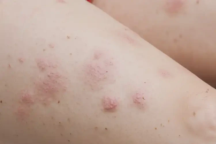 產(chǎn)婦大腿出濕疹可以治好嗎(圖4)