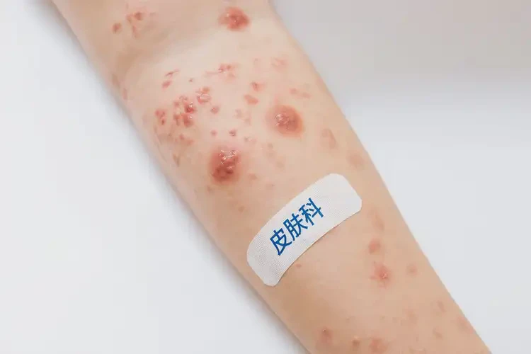 青少年手臂上有濕疹可不可以根治(圖4)