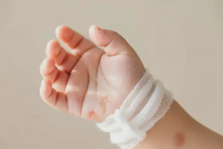 寶寶手上經(jīng)常長(zhǎng)濕疹可以治好嗎(圖3)