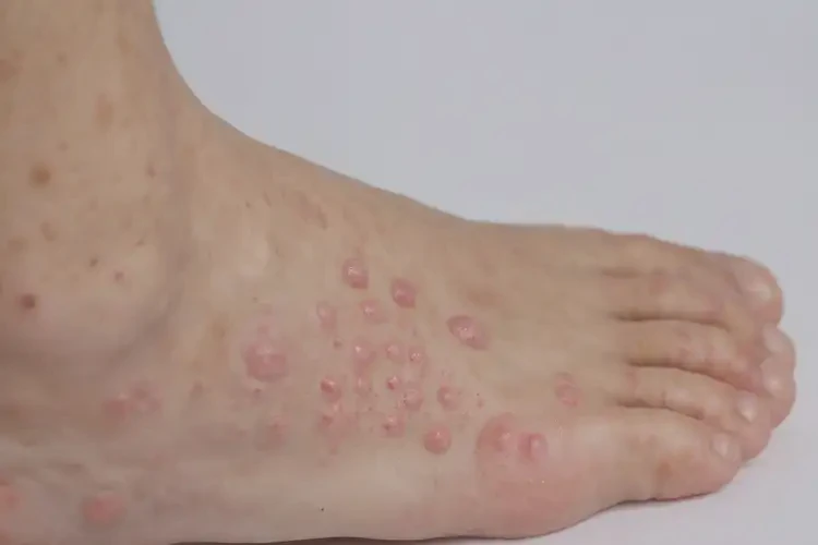 中學(xué)生腳上有濕疹可不可以根治(圖4)
