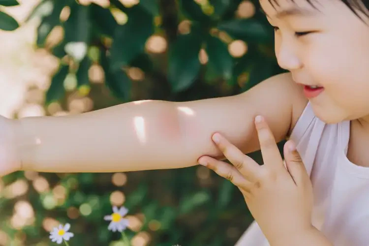 小孩手臂上出現(xiàn)濕疹可以治好嗎(圖4)