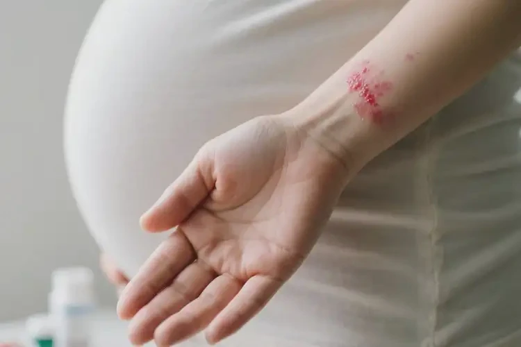 孕婦手臂出現(xiàn)濕疹可以治好嗎(圖1)