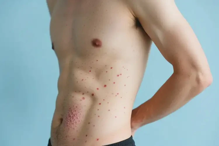 男人肚子偶爾長濕疹可不可以根治(圖2)