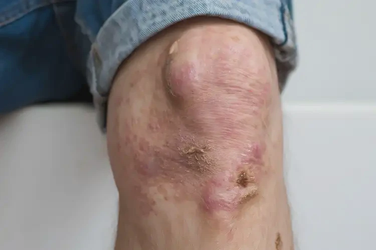 大學(xué)生小腿出現(xiàn)濕疹可不可以根治(圖3)