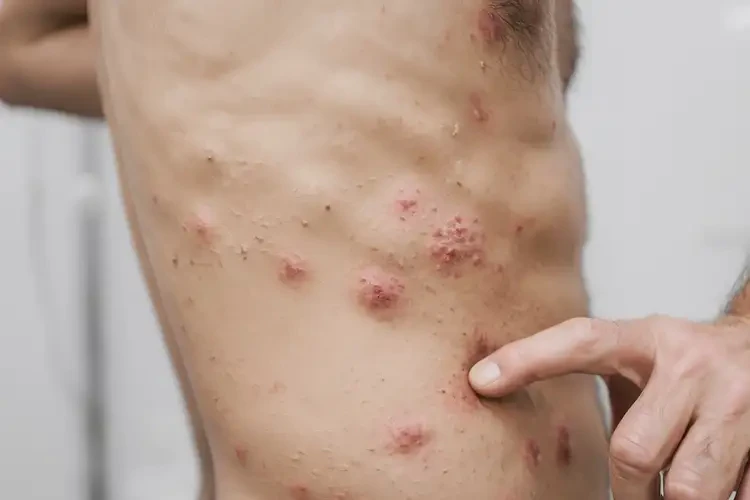 男性屁股出濕疹不管它會自己痊愈嗎(圖4)