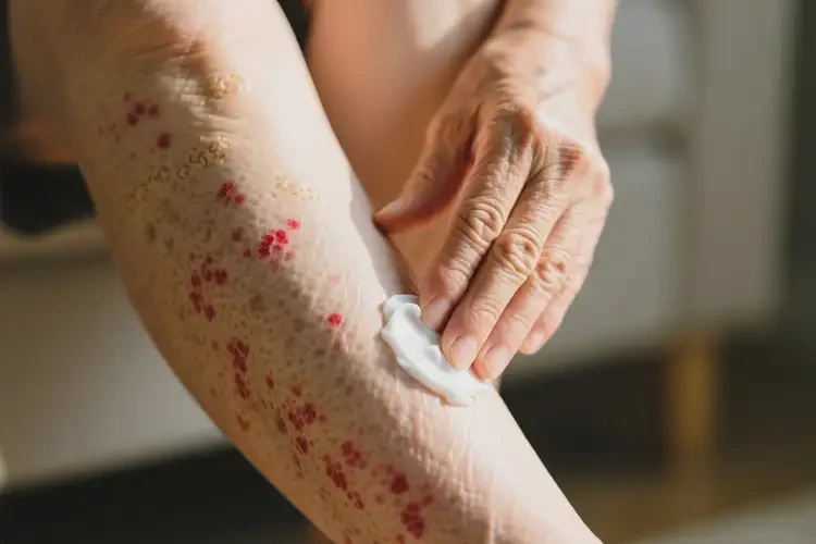 老人大腿經(jīng)常長濕疹可以治好嗎(圖4)