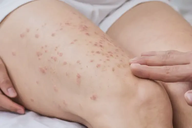 產(chǎn)婦大腿上偶爾長濕疹不管它會(huì)自己自愈嗎(圖4)