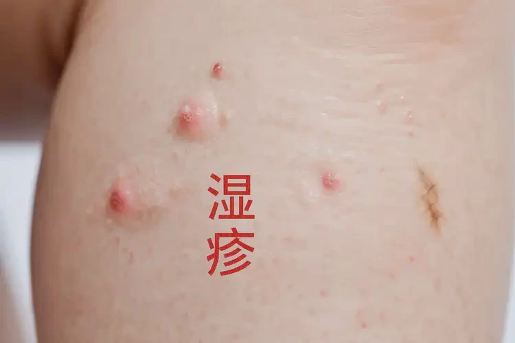 孩子小腿上出現(xiàn)濕疹可以治好嗎(圖4)