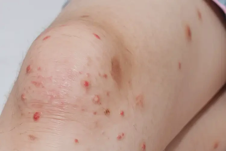 小學(xué)生大腿上容易起濕疹可不可以根治(圖4)