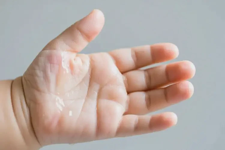 寶寶手上起濕疹可以治好嗎(圖1)