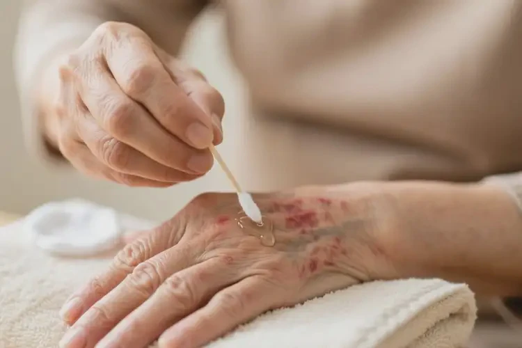 老年人身上容易起湿疹可不可以根治(图3)