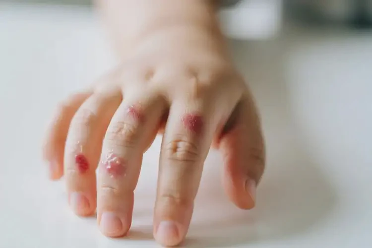 少兒手上容易長濕疹可以治好嗎(圖1)