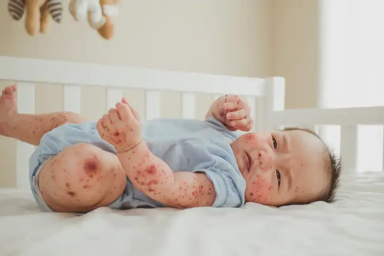 嬰幼兒四肢容易長(zhǎng)濕疹可以治好嗎(圖3)