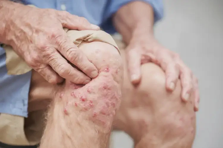 老人大腿上經(jīng)常起濕疹可以治好嗎(圖4)