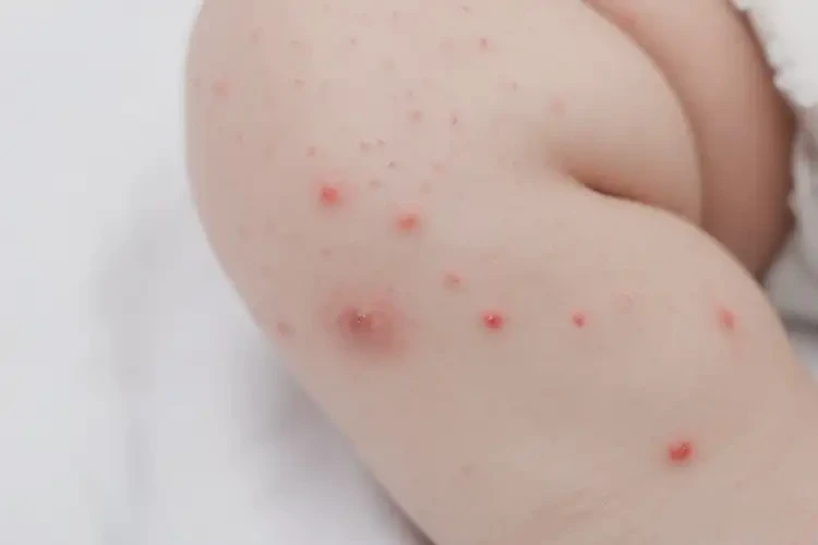 寶寶大腿出濕疹可以治好嗎(圖4)