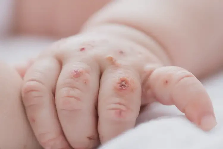 嬰兒手上有濕疹可以治好嗎(圖4)