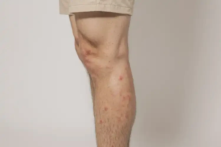 青年人小腿上偶尔起湿疹可不可以彻底自愈(图2)